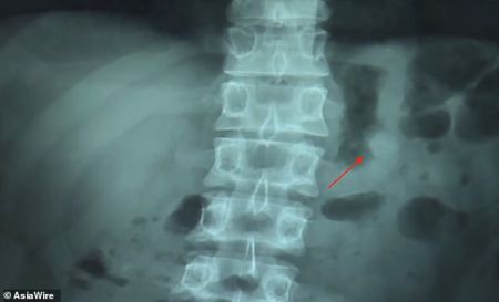 Κατάπιε τα ασύρματα ακουστικά του αλλά αυτά συνέχισαν να λειτουργούν