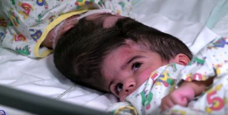 Λονδίνο: Επιτυχής διαχωρισμός σιαμαίων με ενωμένα κεφάλια μετά από 50 ώρες χειρουργείο