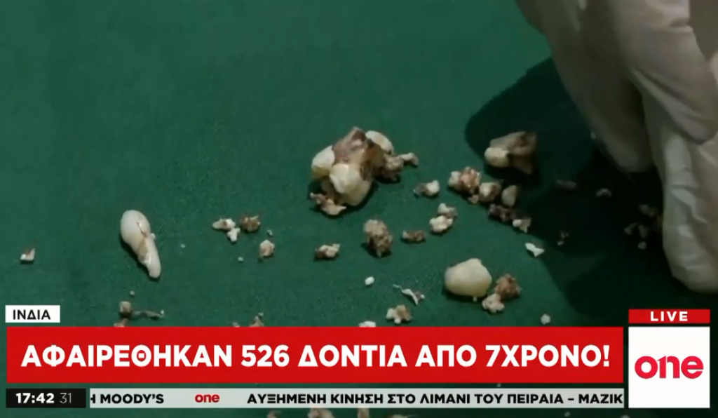 Ινδία: Αφαίρεσαν 526 δόντια από 7χρονο