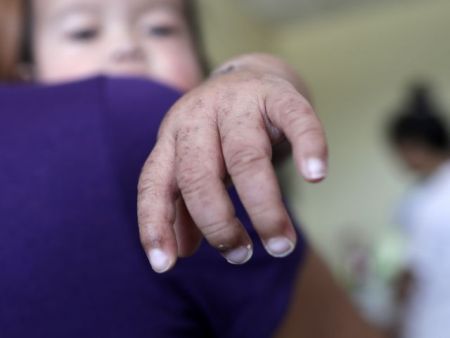 «Σαρώνει» η ιλαρά στην Ευρώπη – «Δεν έχει εξαλειφθεί στην Ελλάδα»