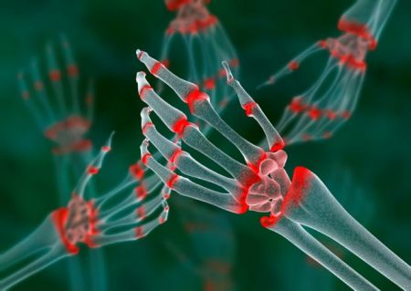 Ακόμη και παιδιά πλήττουν οι ρευματικές παθήσεις