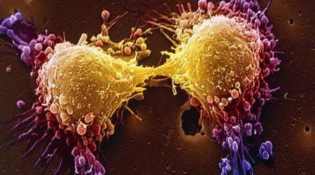 Καρκίνος προστάτη : Γιατί οι άνδρες με υψηλή τεστοστερόνη κινδυνεύουν περισσότερο