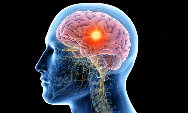 Ογκος στον εγκέφαλο : Νέο τεστ με τεχνητή νοημοσύνη δίνει έγκαιρα διάγνωση