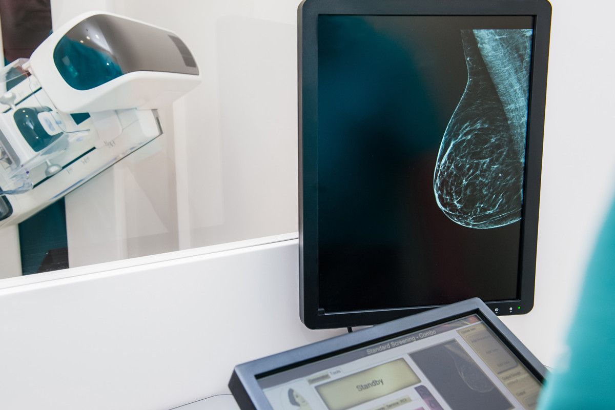 Η τεχνητή νοημοσύνη στη μάχη ενάντια του καρκίνου του μαστού