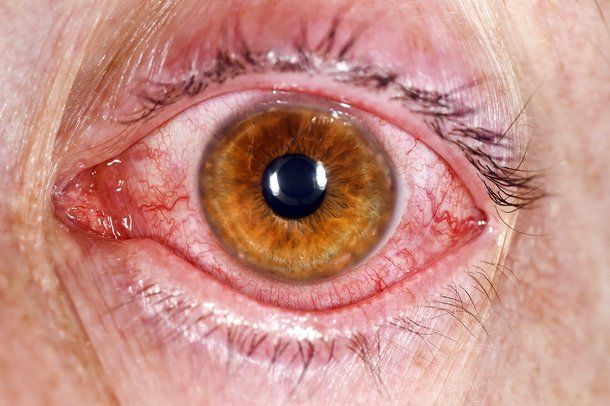 Κορωνοϊός: Τα ερεθισμένα μάτια ένα από τα «ύποπτα» συμπτώματα του ιού
