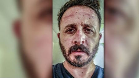 Τα εμφανή σημάδια της μάσκας στο πρόσωπο του ακτινολόγου