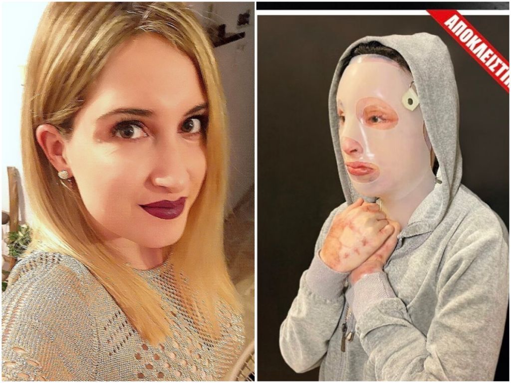 Συγκλονίζει η Ιωάννα στην πρώτη συνέντευξη μετά την επίθεση με βιτριόλι