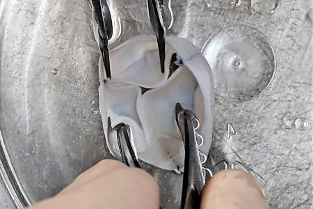 Καρδιακές βαλβίδες εργαστηρίου καταργούν την ανάγκη για πολλαπλές επεμβάσεις