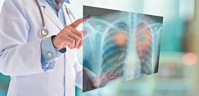 Ανοσοθεραπεία: Η μεγάλη ελπίδα για τον καρκίνο του πνεύμονα