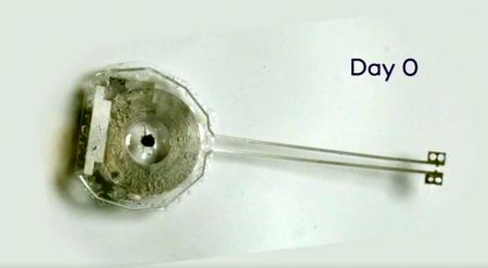 Βηματοδότης διαλύεται μόνος του όταν είναι αχρείαστος