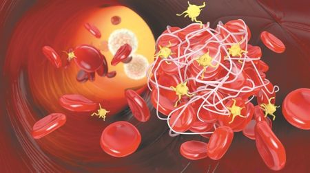 Αποτελεσματικές τεχνικές για την καταπολέμηση της οξείας φλεβικής θρόμβωσης