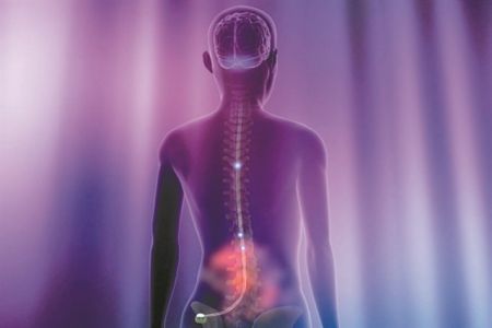 Ηλεκτρόδια εναντίον της νόσου του Crohn