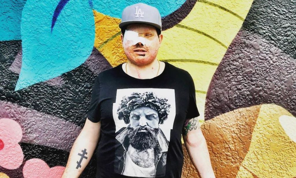 Ανδρέας Χριστοφέρος – Συγκλονίζει μιλώντας για την επίθεση με οξύ που έχει δεχτεί – Το μήνυμά του στην Ιωάννα Παλιοσπύρου