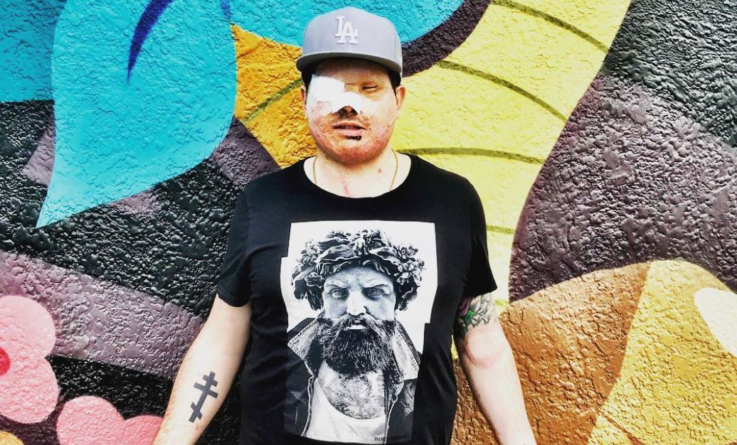 Ανδρέας Χριστοφέρος – Συγκλονίζει μιλώντας για την επίθεση με οξύ που έχει δεχτεί – Το μήνυμά του στην Ιωάννα Παλιοσπύρου