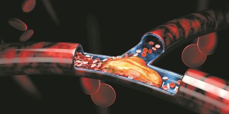 Νέες εξελίξεις στην αντιμετώπιση της χρόνιας φλεβικής θρόμβωσης και του μεταθρομβωτικού συνδρόμου