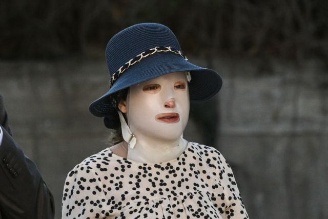 Επίθεση με βιτριόλι – «Διέτρεξε κίνδυνο ζωής, ήρθε αντιμέτωπη με τρία σοκ»