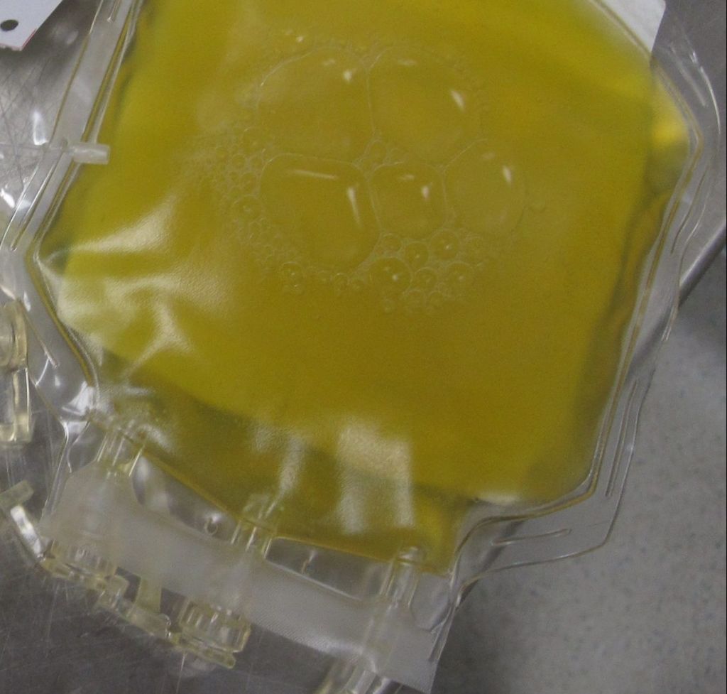 Δεν βοηθά τους σοβαρά ασθενείς με COVID – 19 το πλάσμα όσων έχουν αναρρώσει