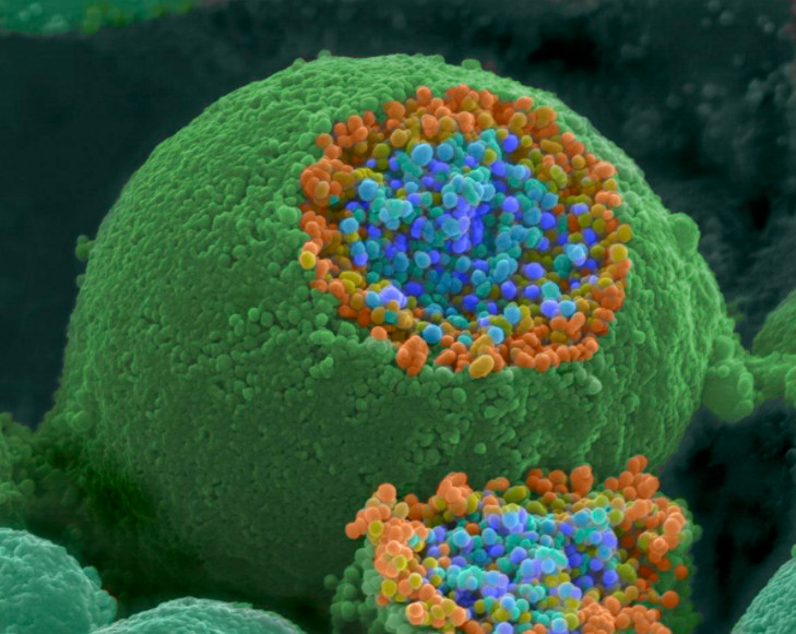 Στην εντατική με κορωνοϊό, από γονίδιο υπεύθυνο για την Αλτζχάιμερ