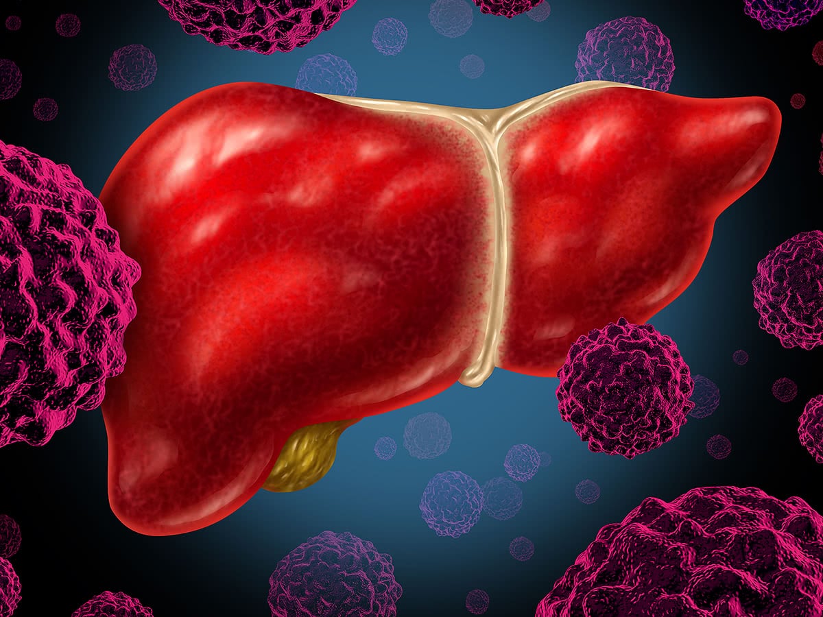 Καινοτόμες θεραπείες και τρόπος ζωής οι λύσεις για τον καρκίνο ήπατος