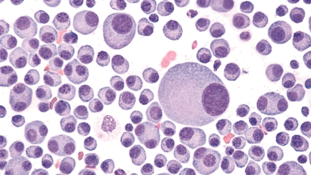 7 ερωτήσεις-απαντήσεις για το πολλαπλό μυέλωμα