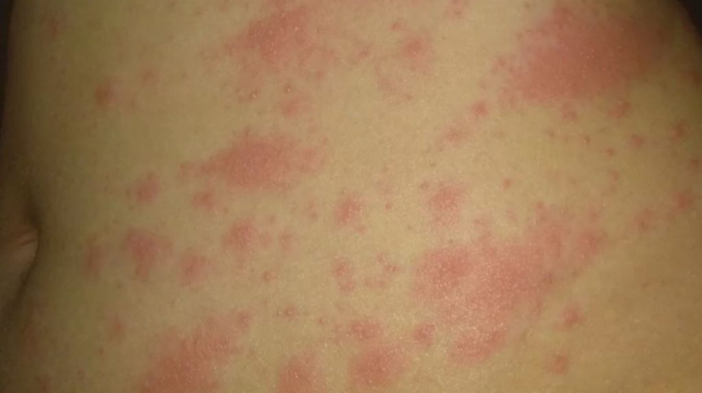 Ομικρον – Αυτά είναι τα δερματικά συμπτώματα που προκαλεί