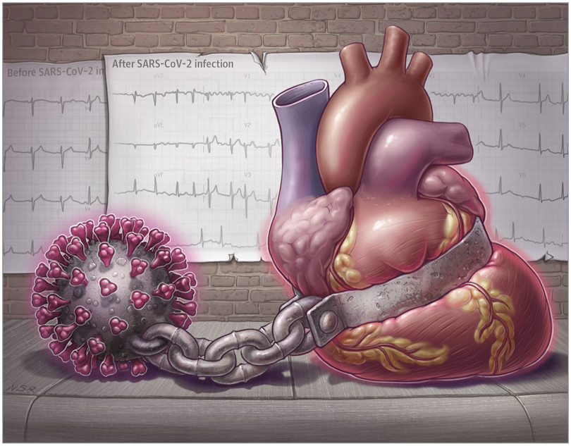 Κίνδυνος για την καρδιά ο κορωνοϊός ακόμα και στην ήπια νόσηση