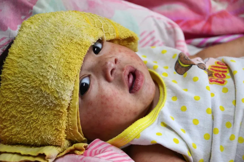 Ιλαρά: Δραματική αύξηση κρουσμάτων λόγω μείωσης των εμβολιασμών