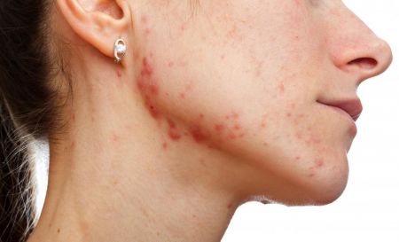 Bρέθηκε διατροφικό «κλειδί» που συνδέεται με την ακμή