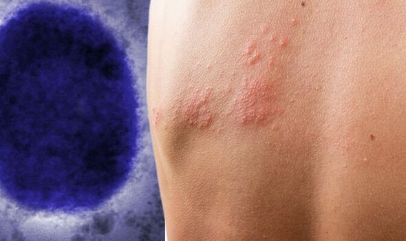 Ύποπτο κρούσμα ευλογιάς των πιθήκων στην Ελλάδα