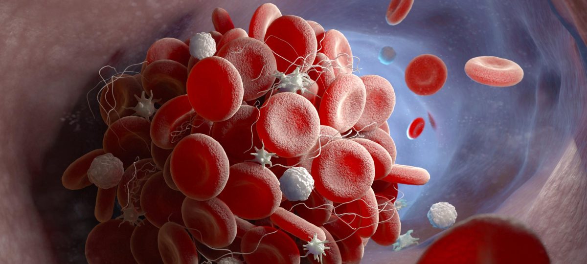 Έρευνα: Οι άνδρες με καρκίνο του προστάτη έχουν πολύ μεγαλύτερο κίνδυνο για σοβαρές θρομβώσεις στο αίμα