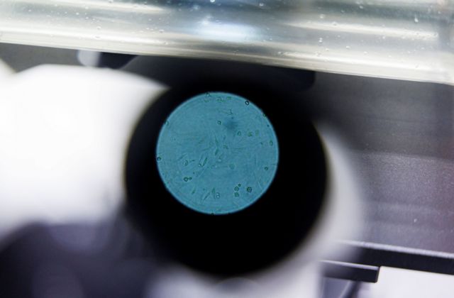 Ευλογιά των πιθήκων: Ποια συμπτώματα μπορεί να έχει κάποιος που νοσεί;