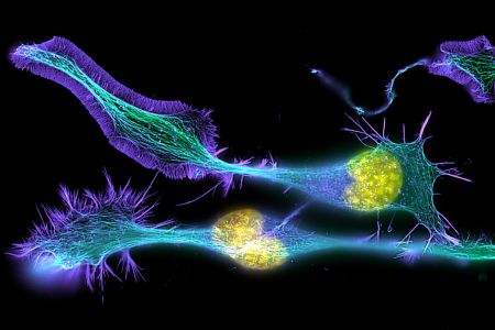Καινούριο γονίδιο ανακαλύφθηκε για τις νόσους του κινητικού νευρώνα