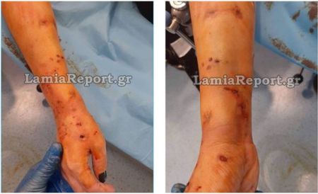 Λαμία: Άγρια επίθεση σκύλου σε 35χρονη – Υπέστη κάταγμα το δεξί χέρι της