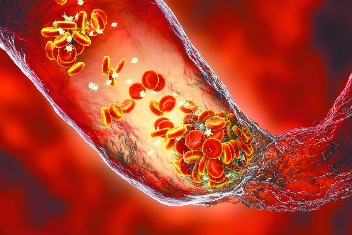 Η ήπια COVID-19 γερνά τις αρτηρίες πιο γρήγορα