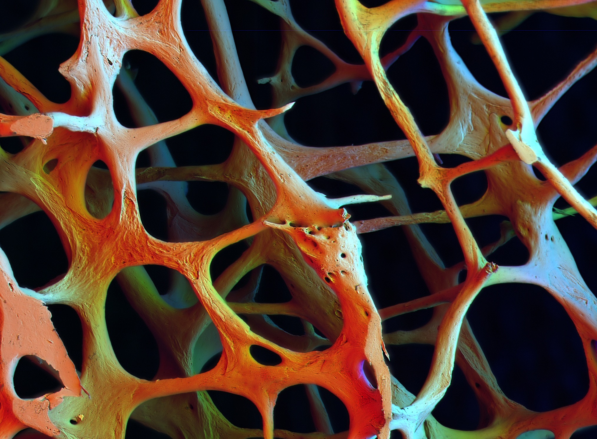 Το βαρύ τίμημα της «επιδημίας» της οστεοπόρωσης για τις γυναίκες