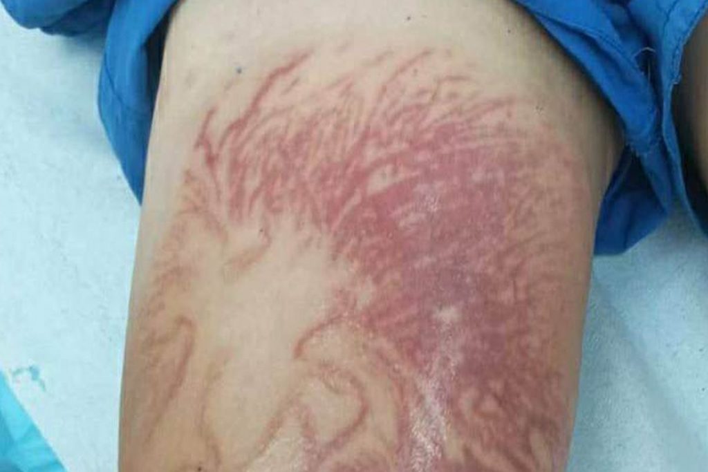 Θαλάσσια ανεμώνη τσίμπησε 9χρονο – Στο νοσοκομείο το παιδί