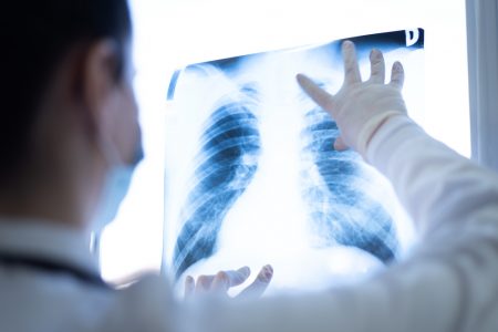 Καρκίνος του πνεύμονα: Αισιόδοξες εξελίξεις στον τομέα της πρόληψης και της αντιμετώπισης