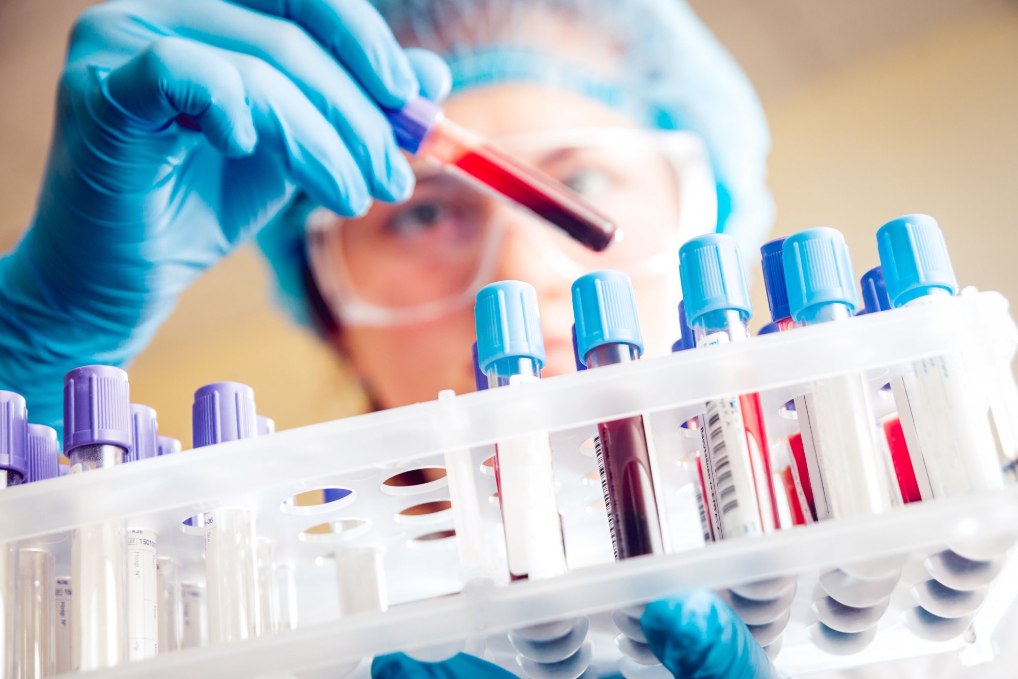 Νέο τεστ αίματος ανιχνεύει 18 μορφές καρκίνου σε πρώιμο στάδιο