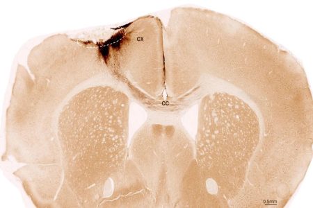 Βλαστοκύτταρα ανέστρεψαν τις βλάβες του εγκεφαλικού