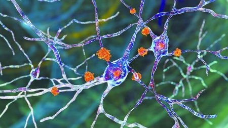 Φρένο στην εξέλιξη της νόσου Χάντινγκτον