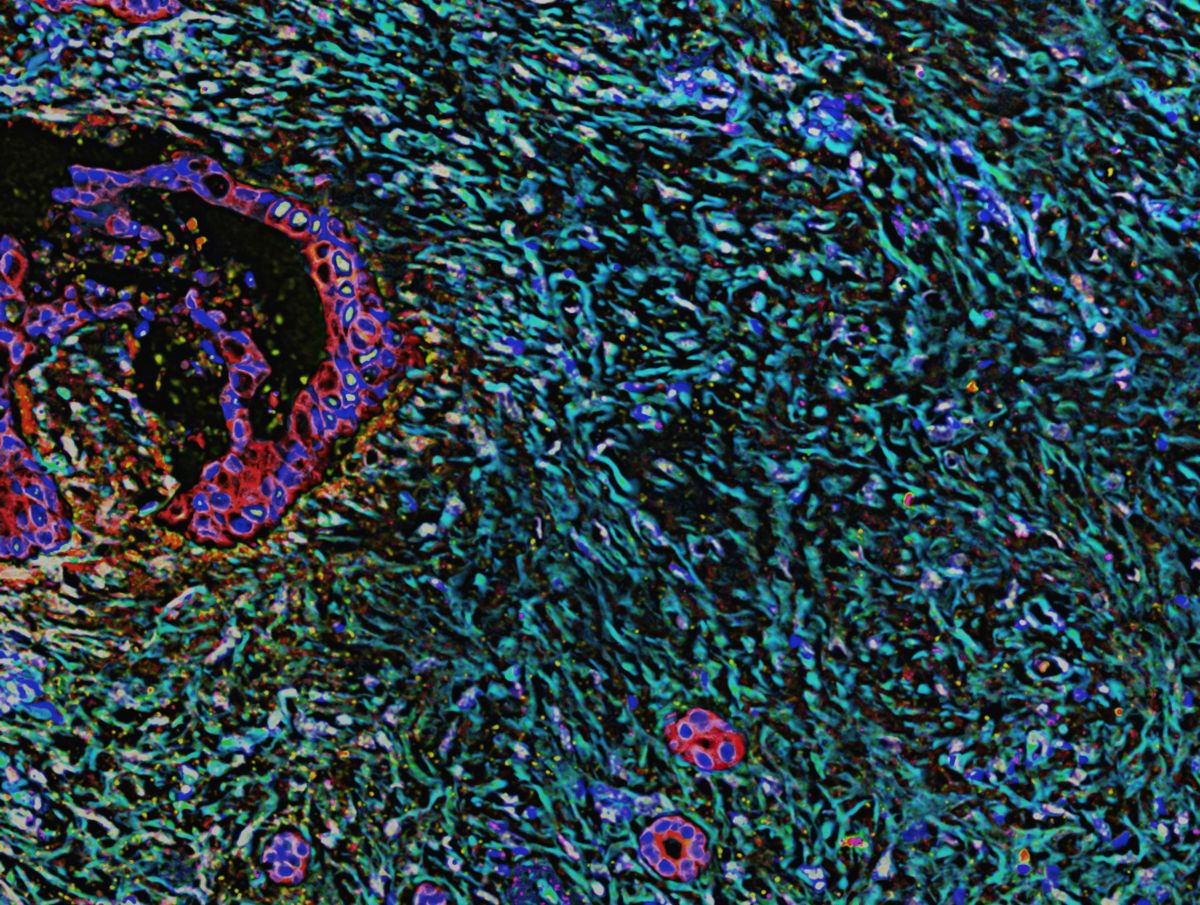 Νέες ελπίδες για τον καρκίνο του παγκρέατος: Το χάπι που μπορεί να αλλάξει τη μάχη