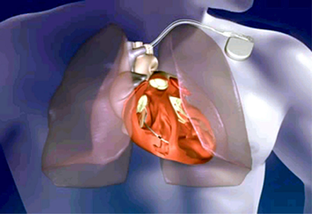 Καρδιαγγειακά νοσήματα: Ανάγκη για σχέδιο θρομβόλυσης και αποκατάστασης