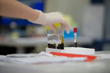 AIDS: Νέα υποχώρηση των μολύνσεων στην Ελλάδα – Προβληματίζουν οι «σιωπηλές» διαγνώσεις