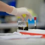 AIDS: Νέα υποχώρηση των μολύνσεων στην Ελλάδα – Προβληματίζουν οι «σιωπηλές» διαγνώσεις