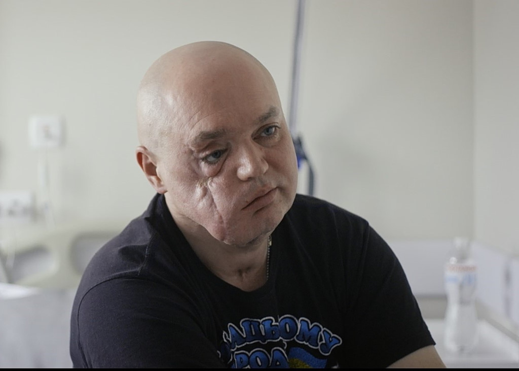 «Αυτό είναι ο πόλεμος»: Τα πρόσωπα που κουβαλούν τα τραύματα της Ουκρανίας | Επικαιρότητα στο PlusTV.gr